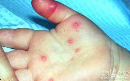 手足口病吃瓜,手足口病防控攻略