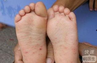手足口病吃瓜,手足口病防控攻略 第2张 手足口病吃瓜,手足口病防控攻略 第2张